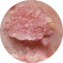 高危hpv