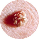 HPV